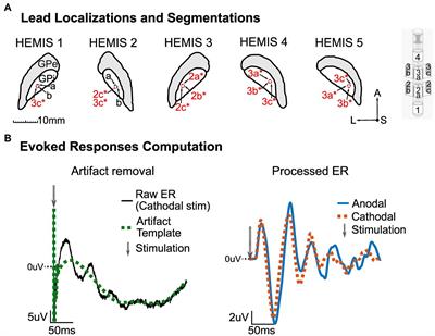 Low-frequency deep brain stimulation reveals resonant beta-band evoked oscillations in the pallidum of Parkinson’s Disease patients